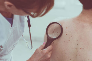 سرطان الجلد أعراض وتشخيص وعلاج